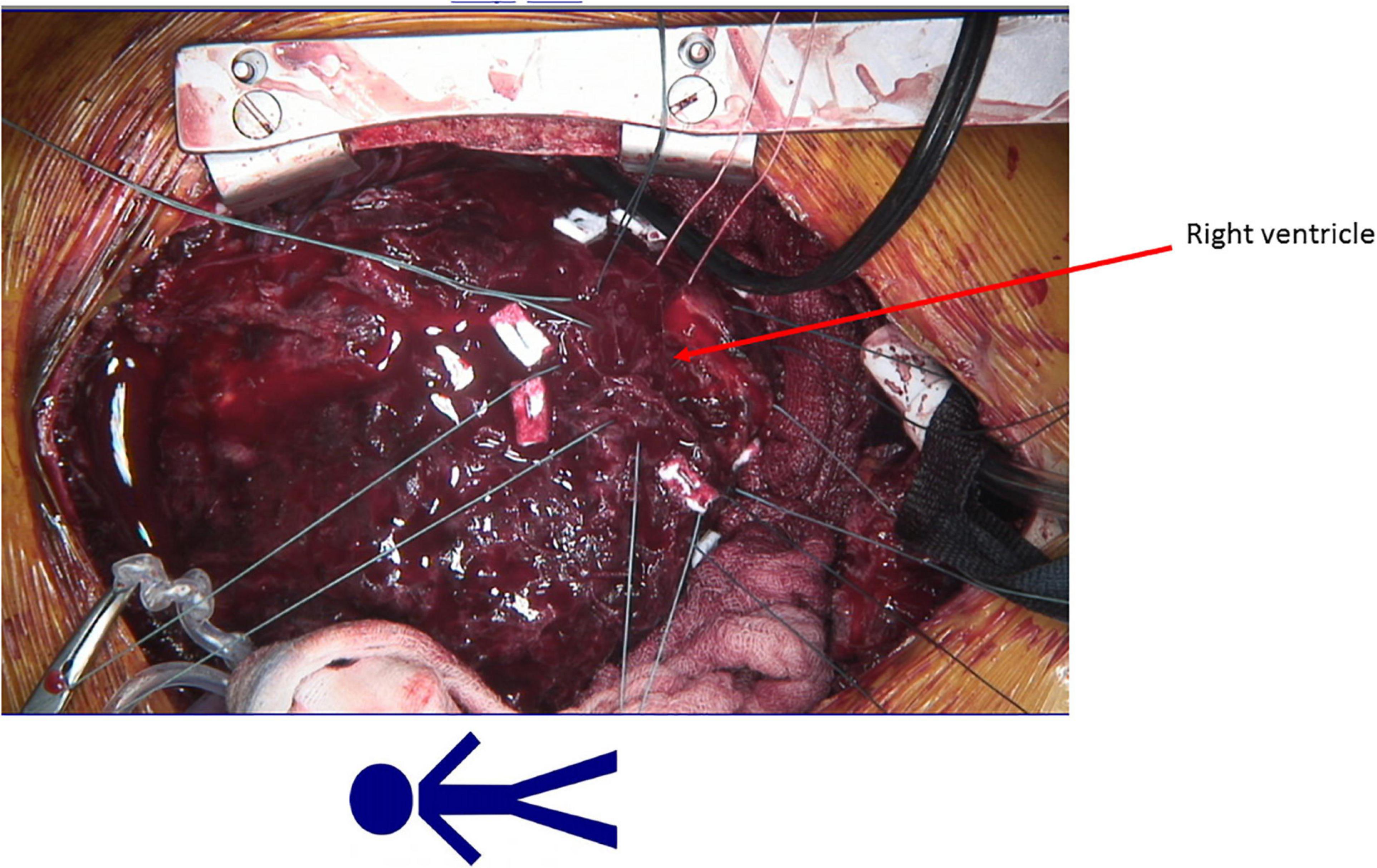 Case report: Heart Mate III for systemic right ventricular support in a patient with hypoplastic left heart syndrome